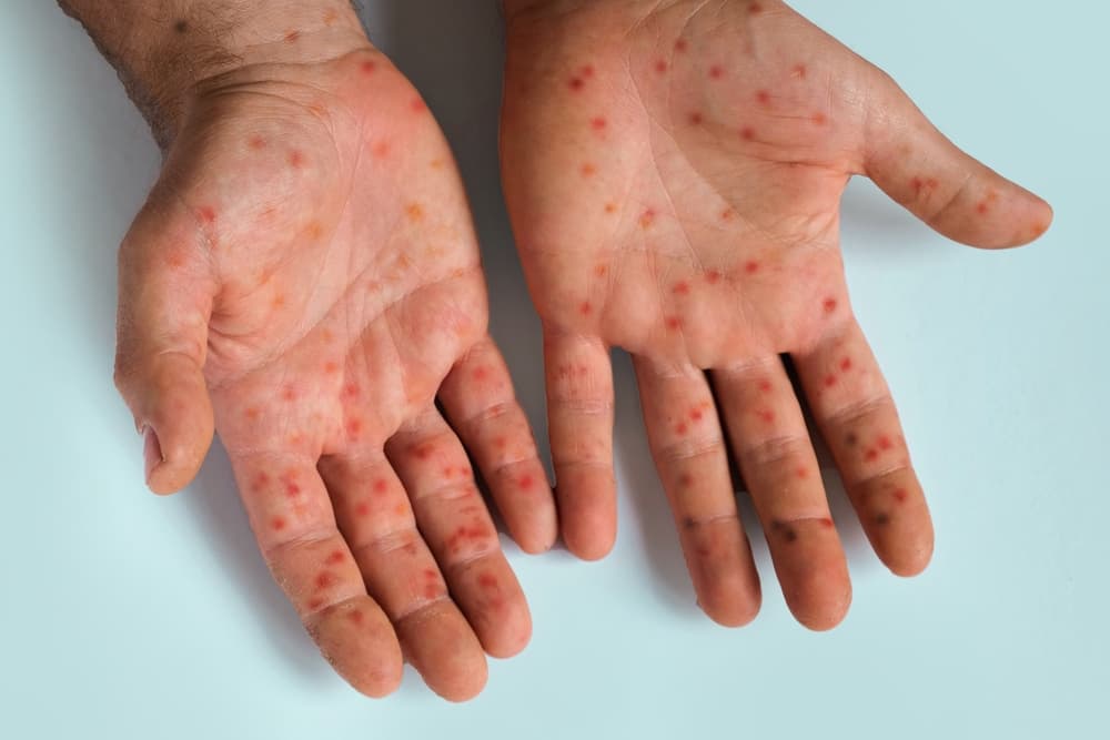 Mãos com pontos vermelhos arredondados, sinais de uma pessoa com sarampo.