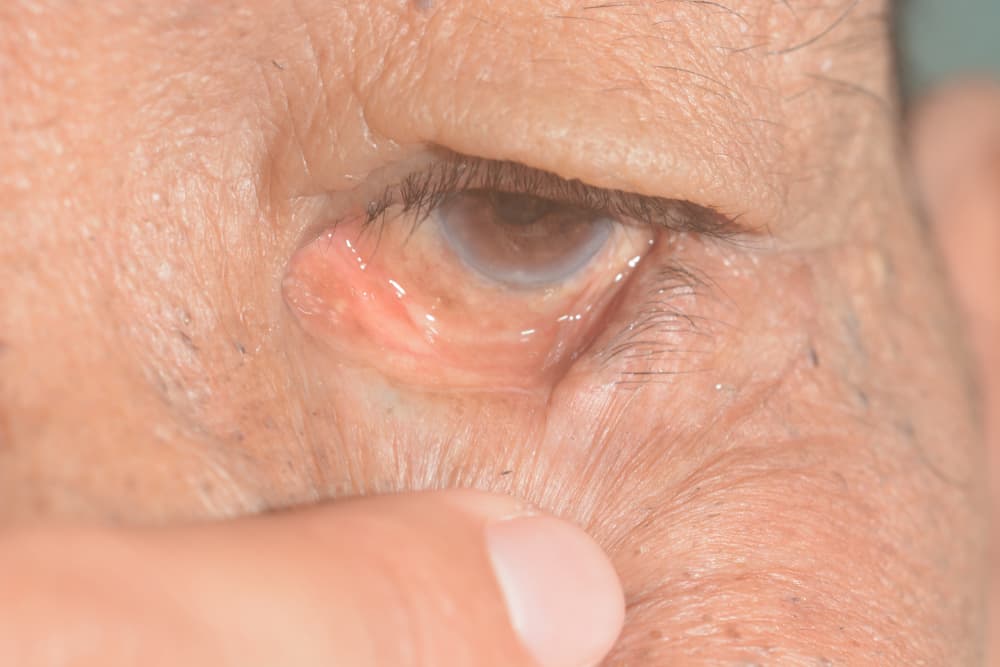 Close,Up,Of,The,Ectropion,During,Eye,Examination.