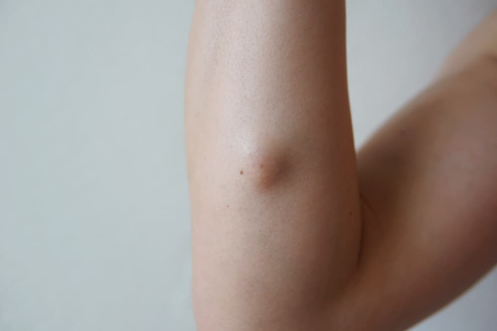 Sebaceous,Cyst,,Treatment,Is,By,Mean,Of,Excision.
