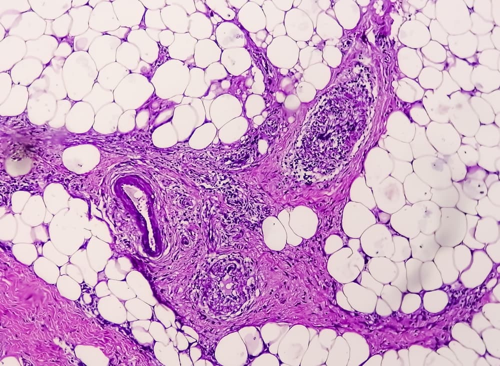 Photomicrograph,Of,Granulomatous,Tissue,Histology,Showing,Foreign,Body,Granuloma.