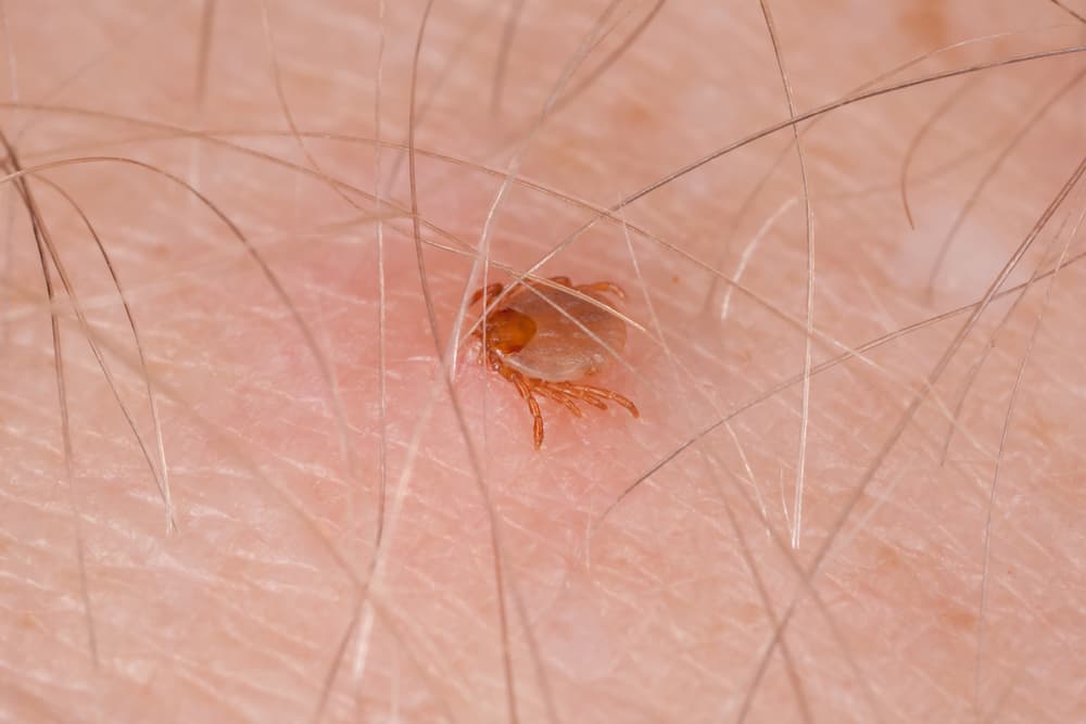Maculosa,Fever,Tick,Drinking,Blood,Biting,Human,Skin,-,Typhoid