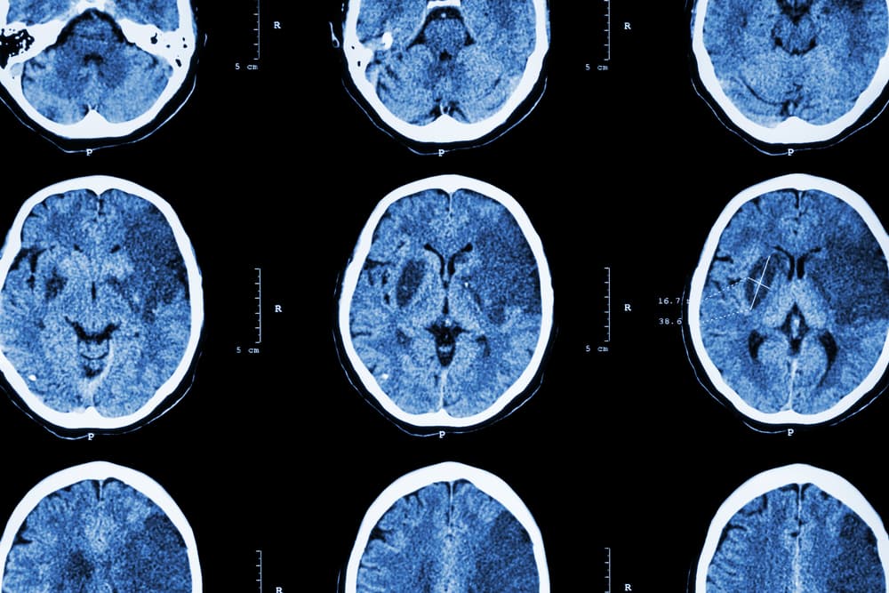 Ischemic,Stroke,:,(,Ct,Of,Brain,Show,Cerebral,Infarction