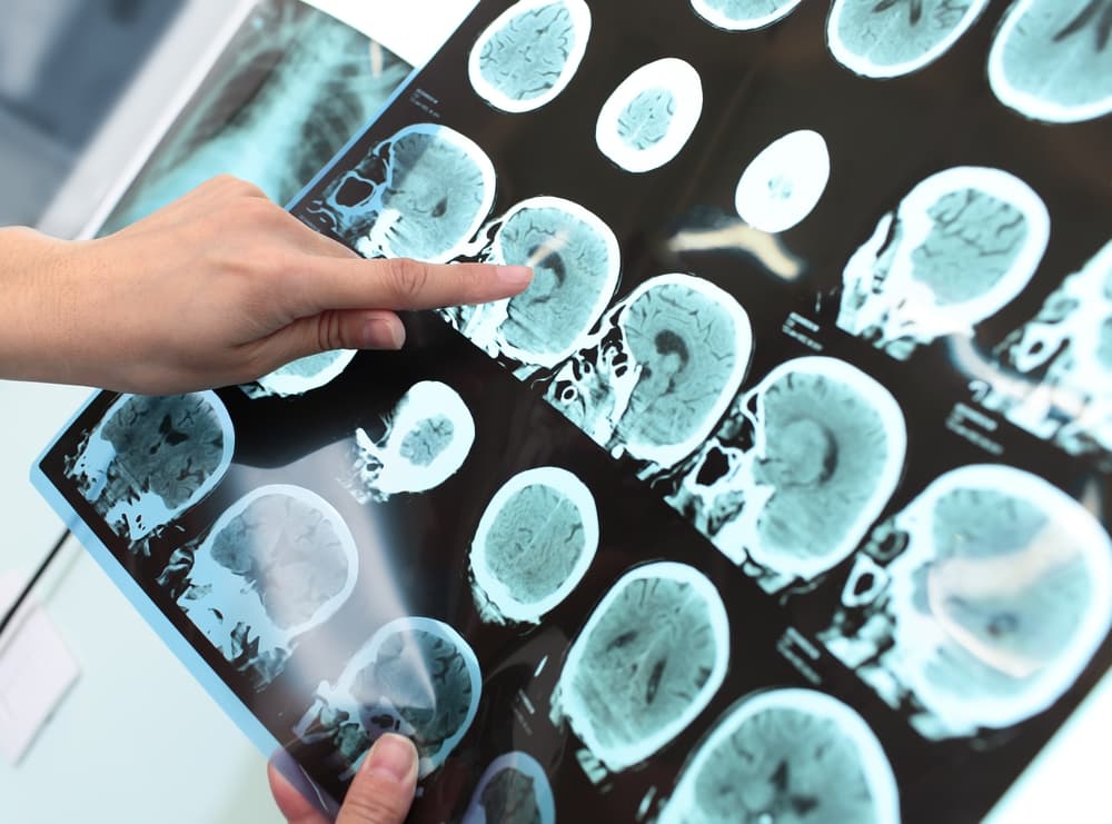 Resultado de uma ressonância magnética para diagnóstico de tumor cerebral.